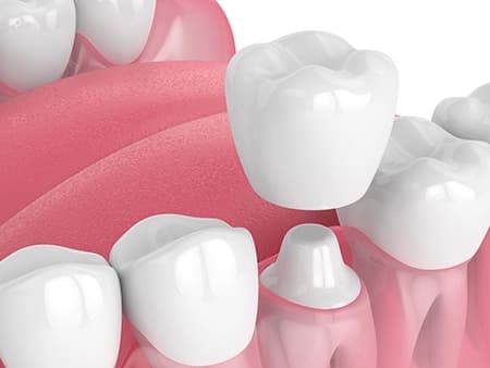 The type of ceramic crown selected depends on your needs